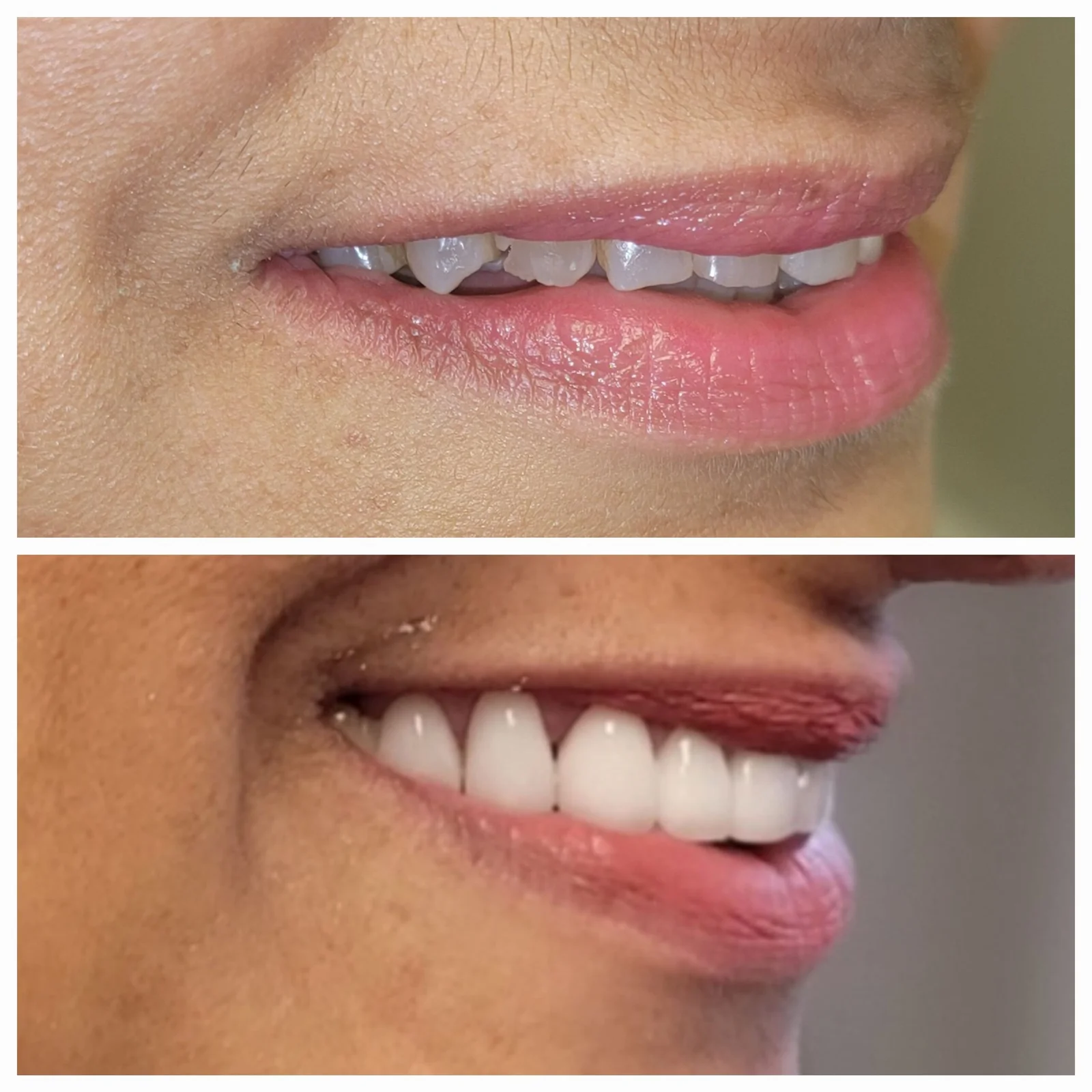 Before and after smile makeover - side profile showing improved smile