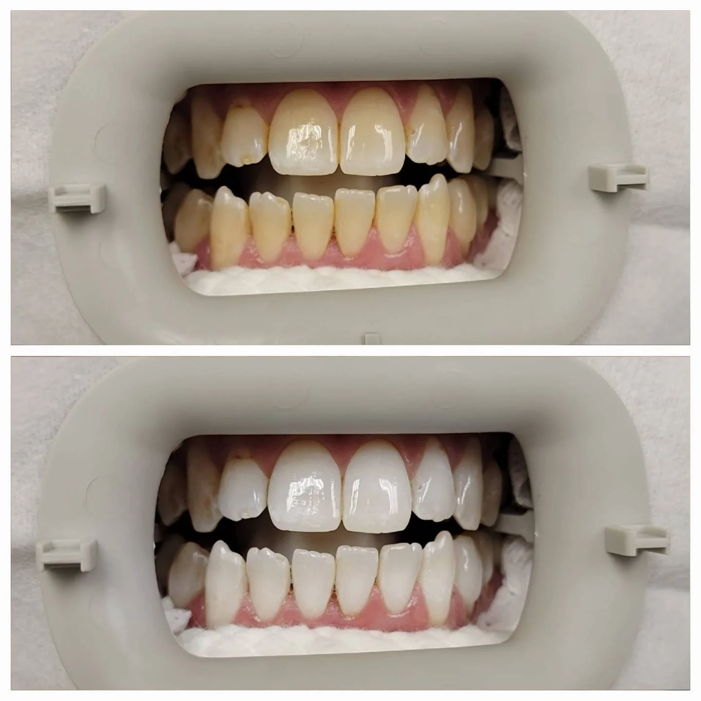 Before and after teeth whitening with dental retractor at Smile Studio Boston