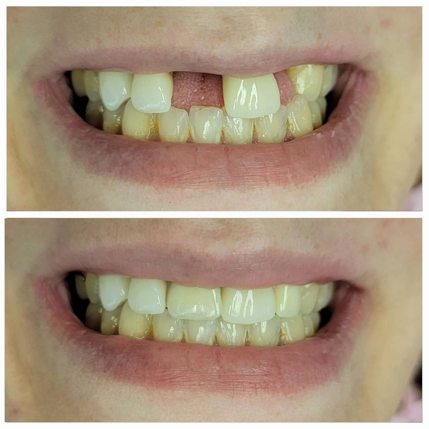 Before and after dental restoration - chipped and missing front teeth repaired