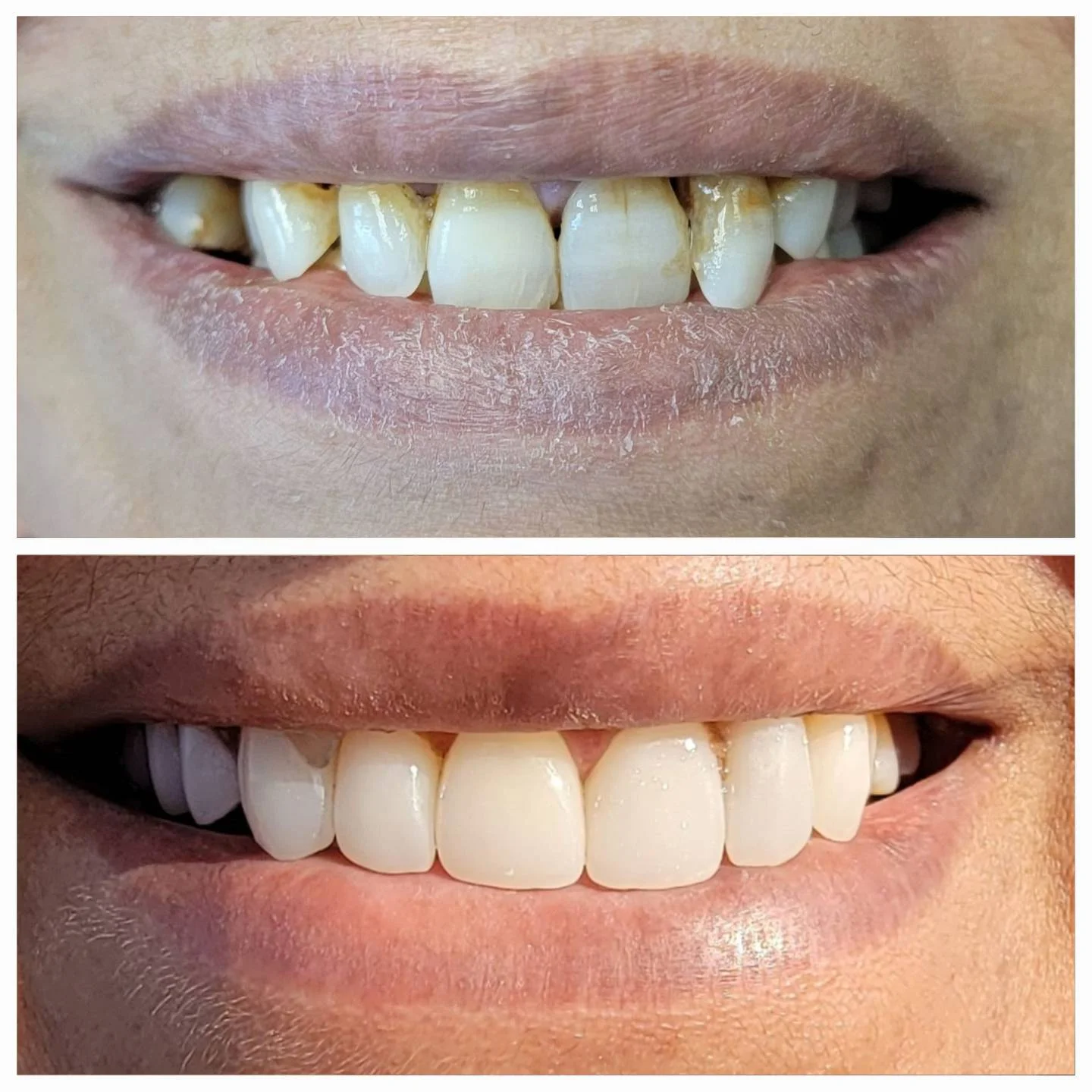 Before and after cosmetic smile makeover - stained teeth transformed