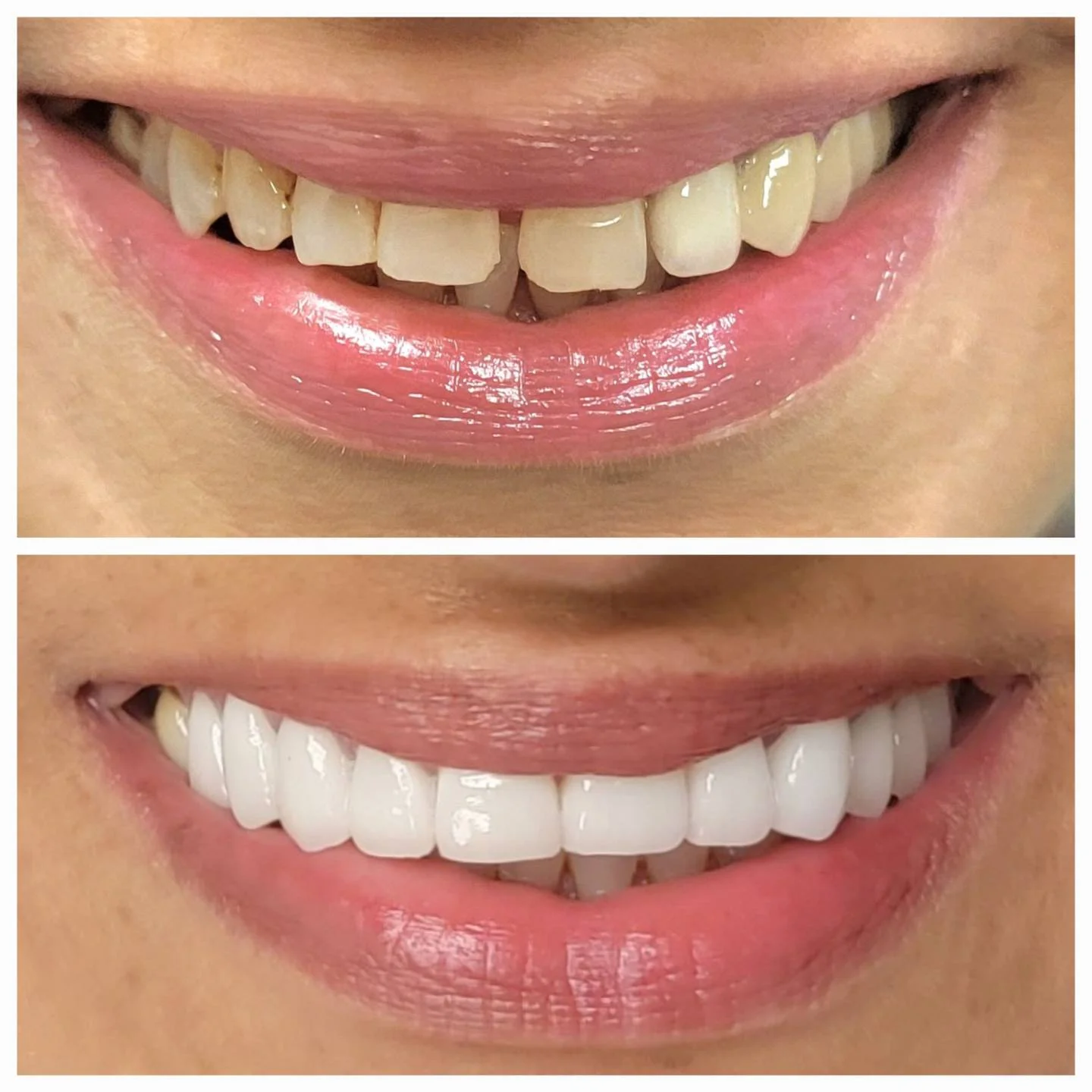 Before and after porcelain veneers - complete smile transformation